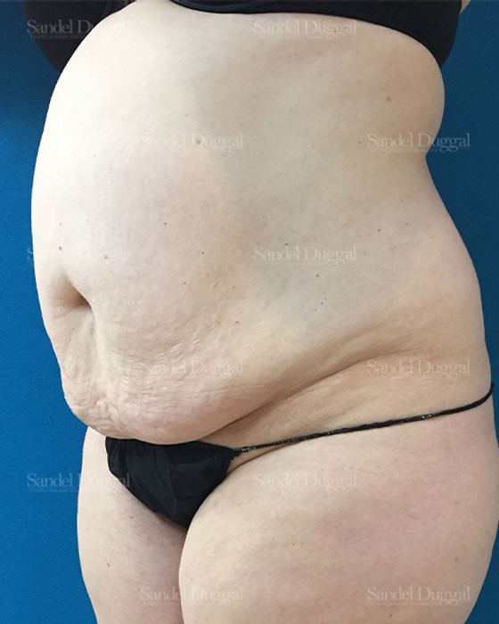 Tummy Tuck before, case 1673