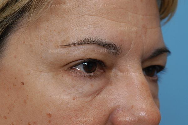Eyelid Rejuvenation before, case 1900