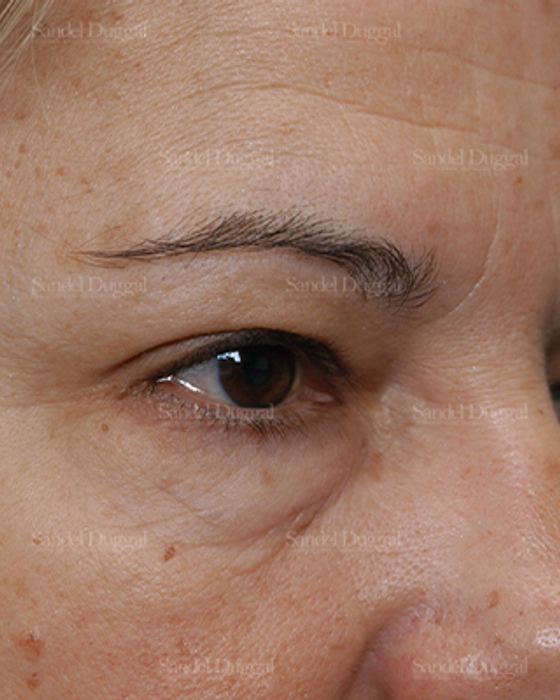 Eyelid Rejuvenation before, case 1900