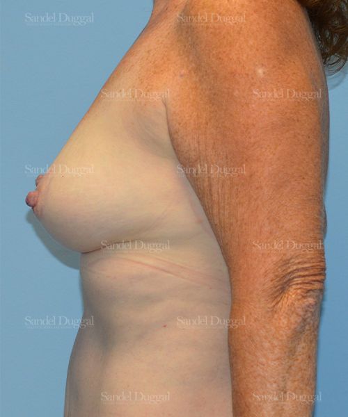 Breast Augmentation with Lift after, case 3365
