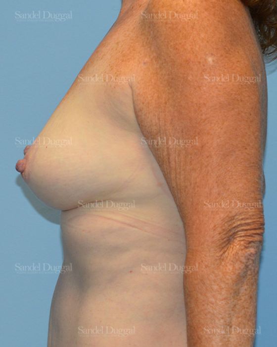 Breast Augmentation with Lift after, case 3365