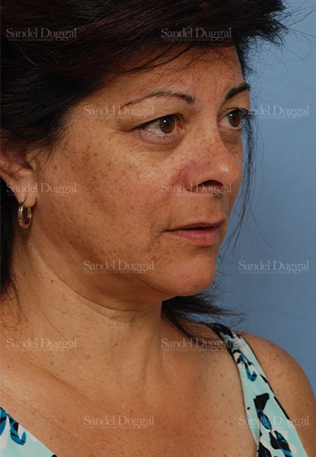 Facelift before, case 2671