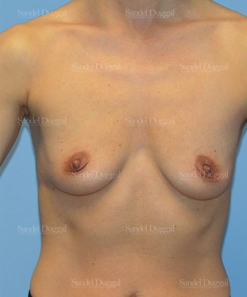 Breast Augmentation before, case 3227