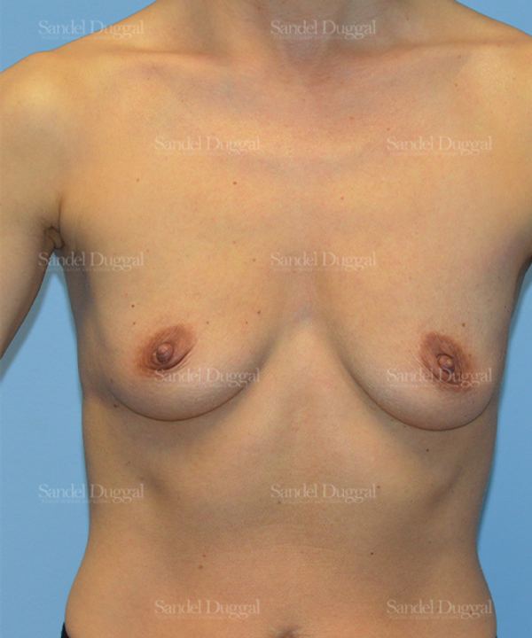 Breast Augmentation before, case 3227