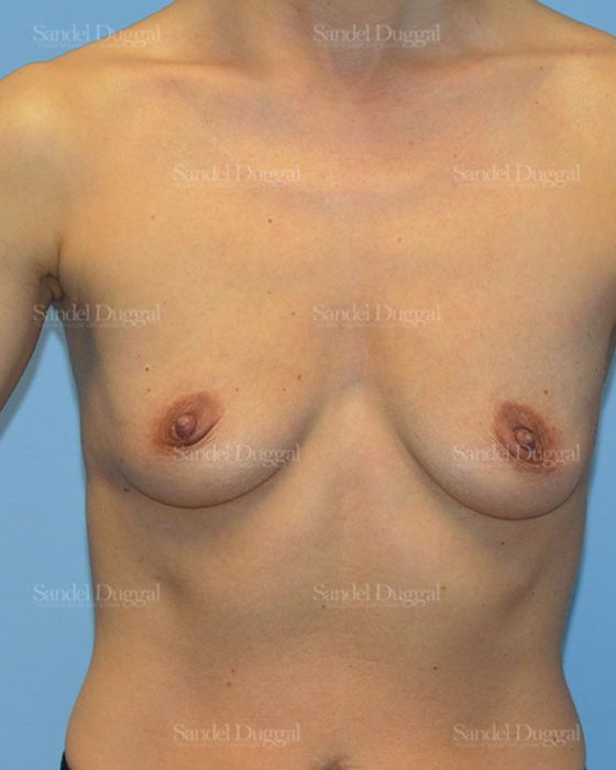 Breast Augmentation before, case 3227