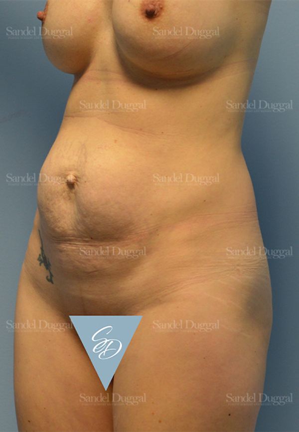 Mommy Makeover before, case 2176