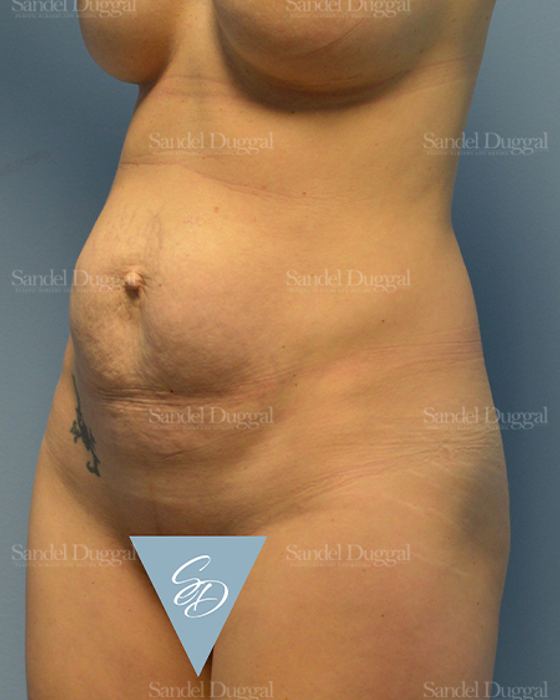 Mommy Makeover before, case 2176