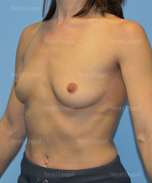 Breast Augmentation before, case 752