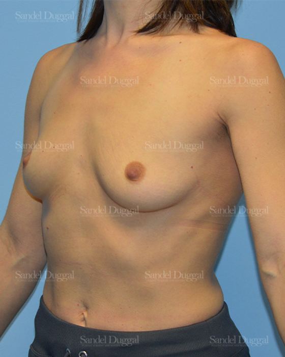 Breast Augmentation before, case 752