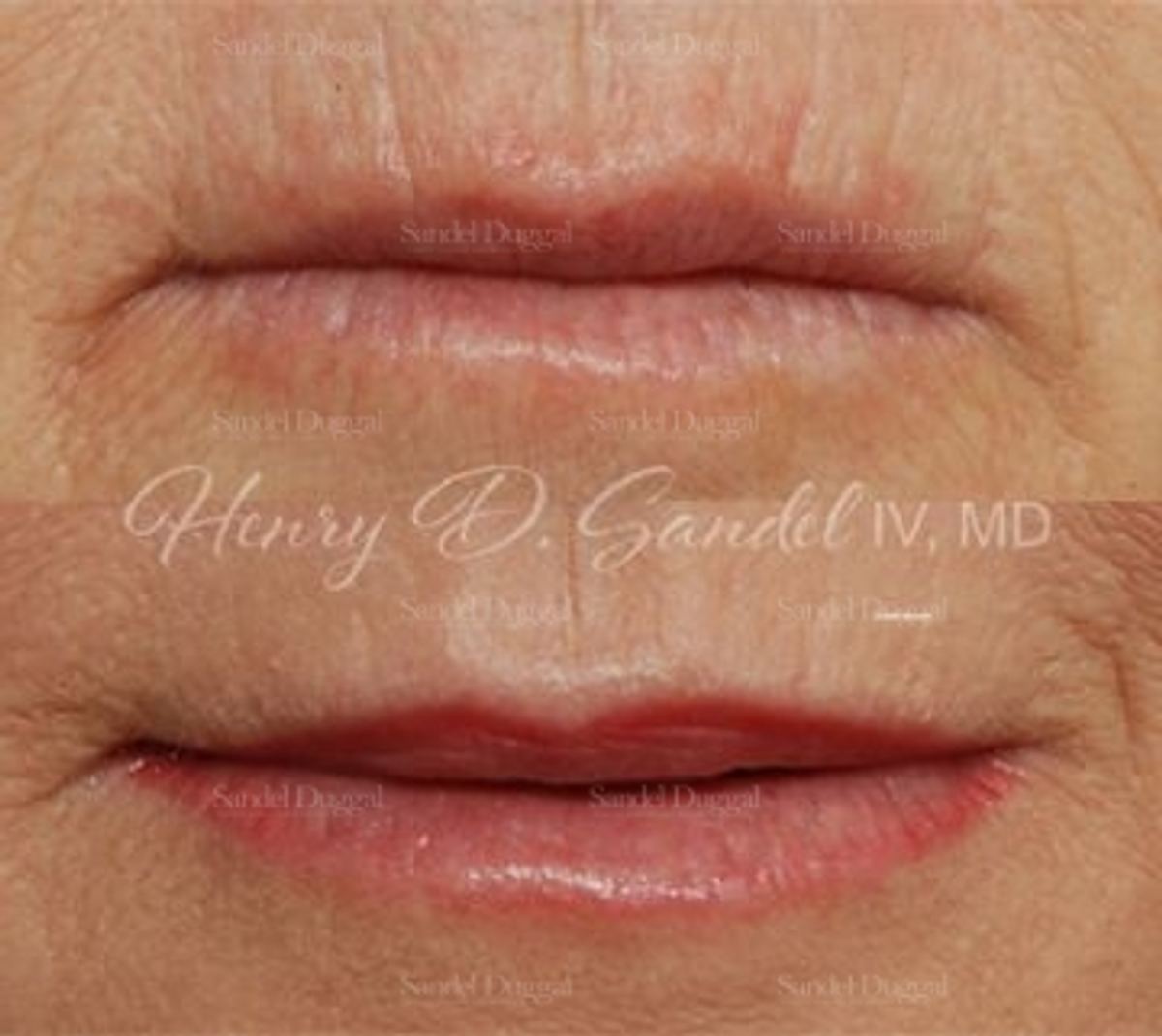 Lip Augmentation / Lip Lift before and after, case 4391