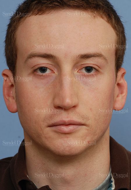 Rhinoplasty before, case 2899