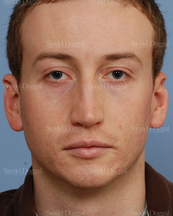 Rhinoplasty before, case 2899