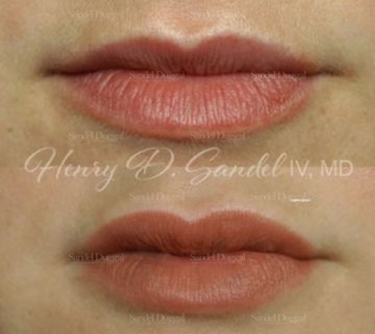 Lip Augmentation / Lip Lift before and after, case 4405