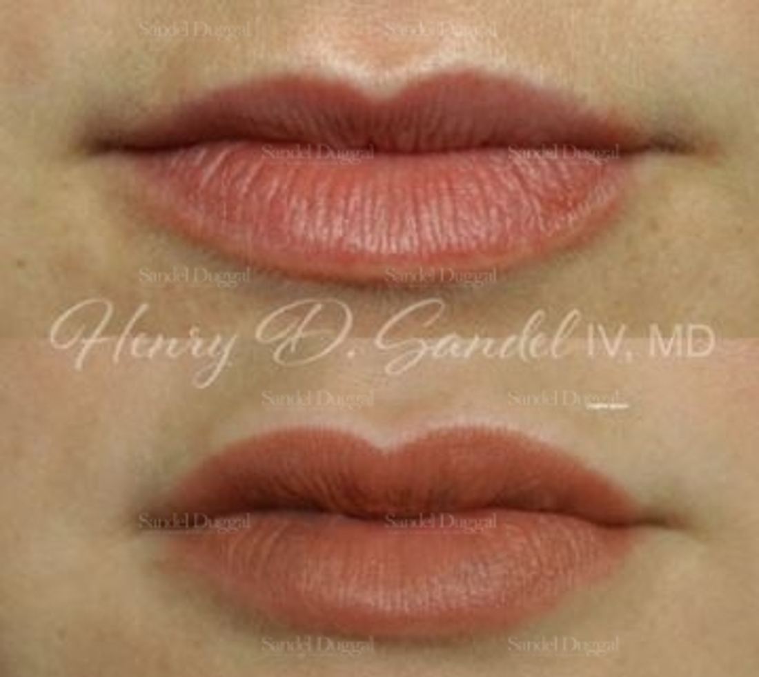 Lip Augmentation / Lip Lift before and after, case 4405