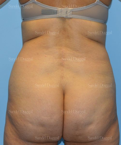 Liposuction — Legs & Flanks before, case 2509