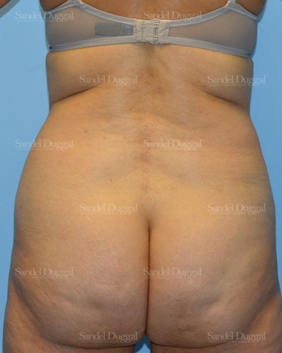 Liposuction — Legs & Flanks before, case 2509