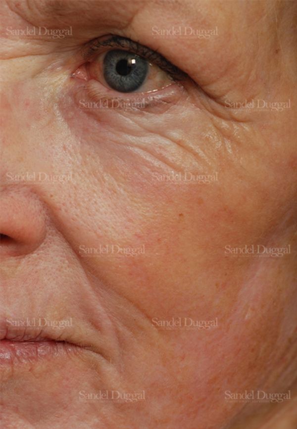 Laser Skin Resurfacing after, case 2969