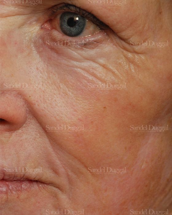 Laser Skin Resurfacing after, case 2969