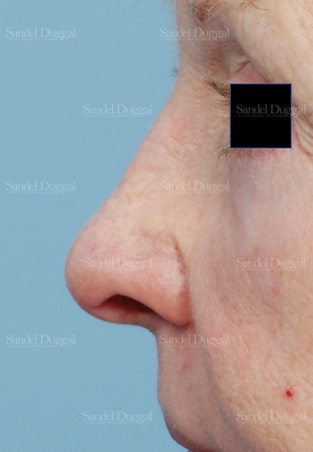 Revision Rhinoplasty after, case 2614