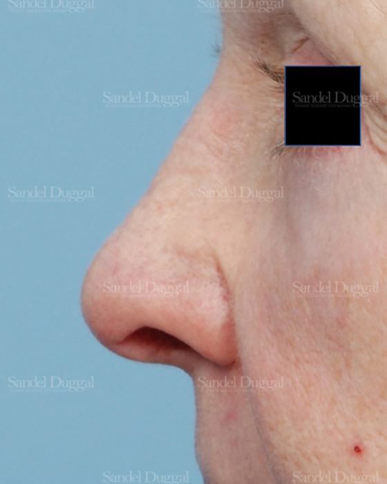 Revision Rhinoplasty after, case 2614