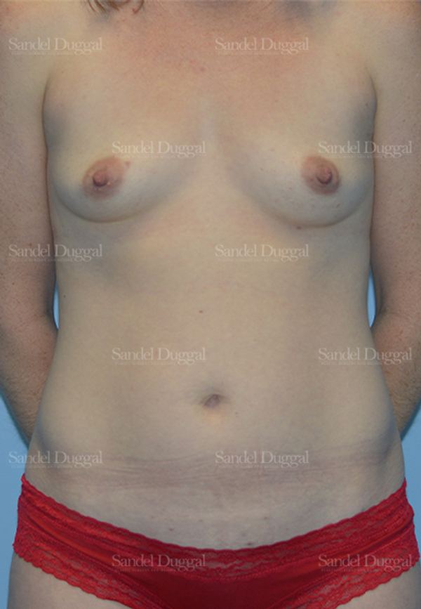 Mommy Makeover before, case 792
