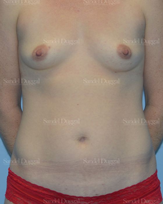 Mommy Makeover before, case 792