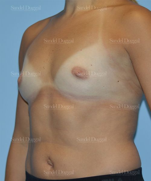 Breast Augmentation before, case 3143