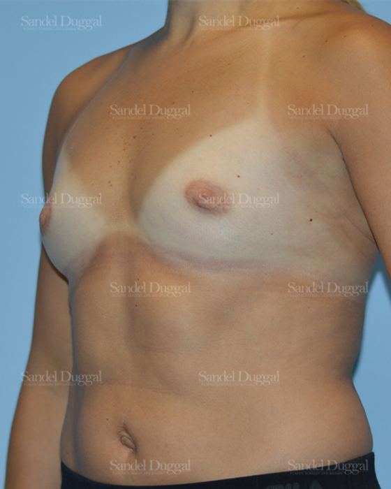 Breast Augmentation before, case 3143