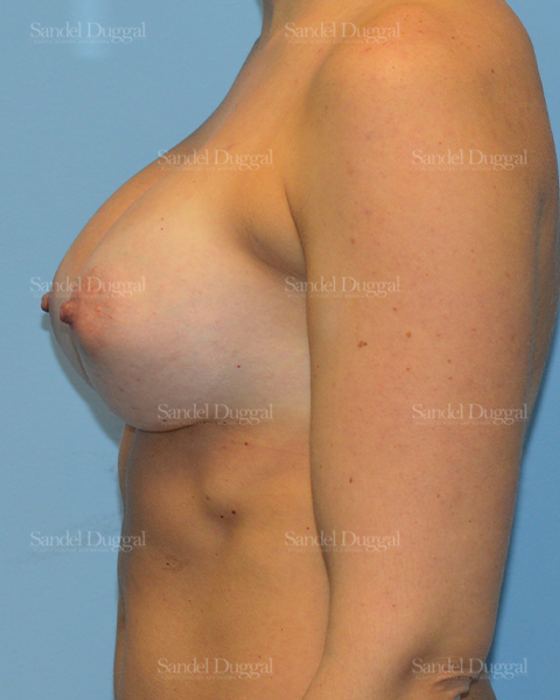 Breast Augmentation after, case 3157