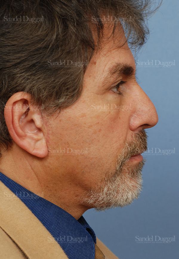 Facelift after, case 2719