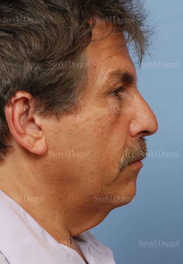 Facelift before, case 2719