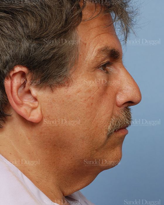 Facelift before, case 2719