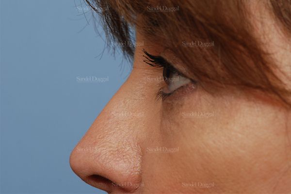 Eyelid Rejuvenation after, case 831