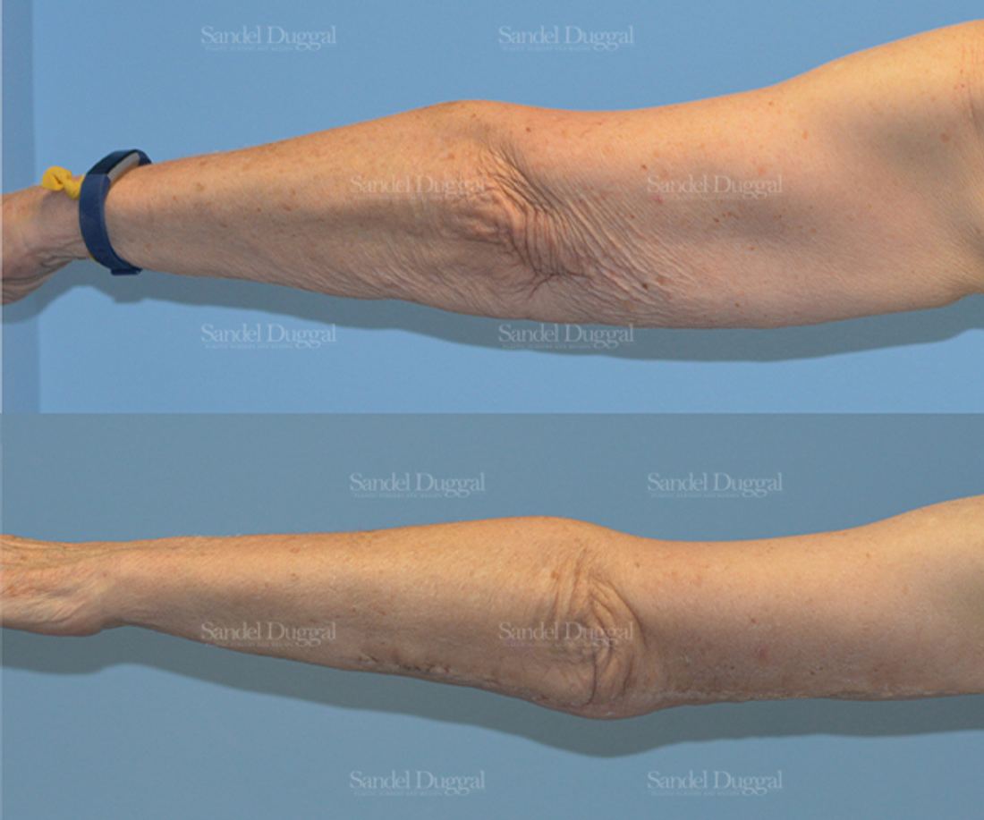 Brachioplasty before and after, case 2118