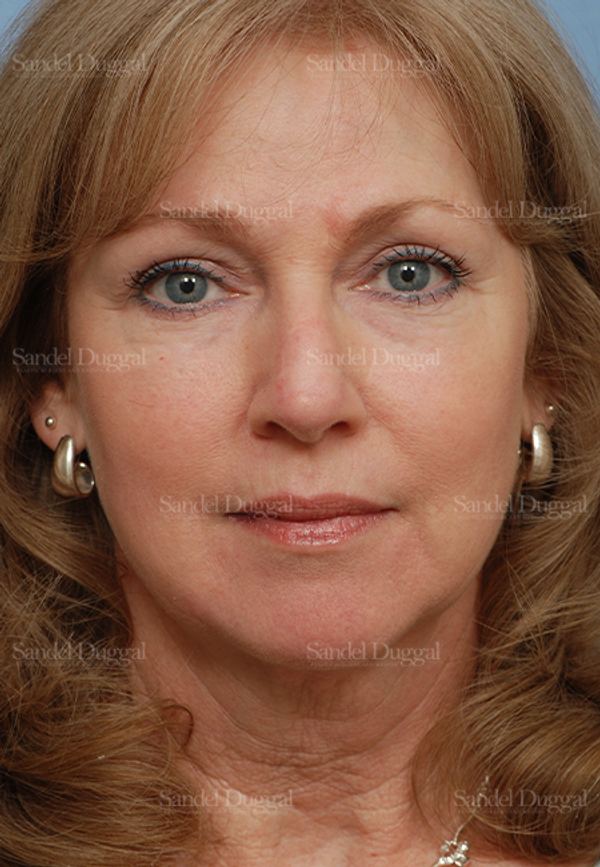 Reconstruction after Mohs after, case 2790