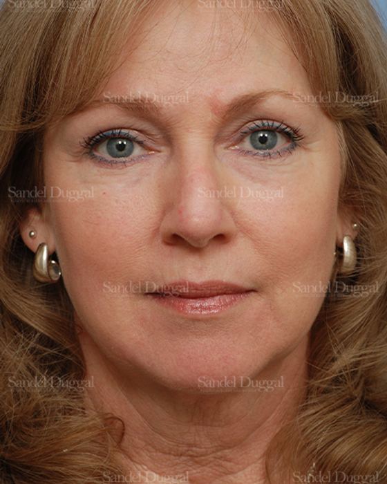 Reconstruction after Mohs after, case 2790