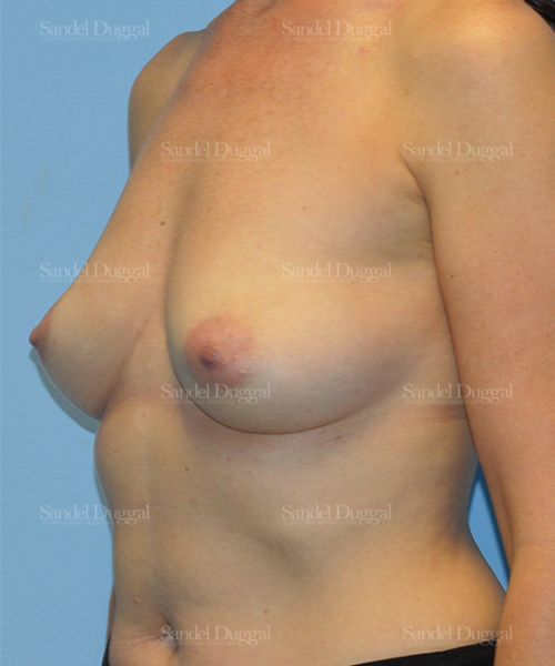Breast Augmentation before, case 3108