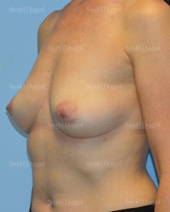 Breast Augmentation before, case 3108