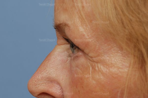 Eyelid Rejuvenation after, case 1951