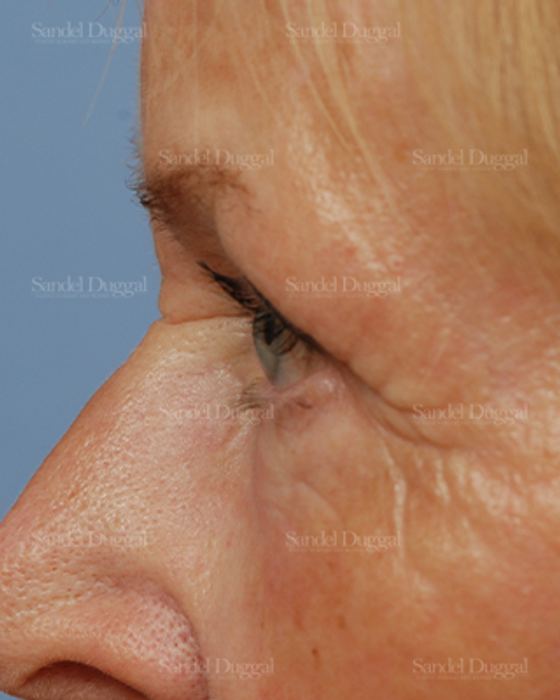 Eyelid Rejuvenation after, case 1951