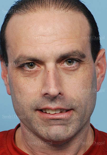 Rhinoplasty before, case 2909