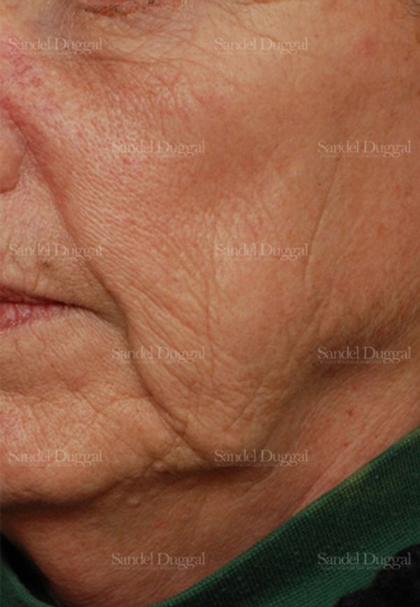 Laser Skin Resurfacing before, case 2975
