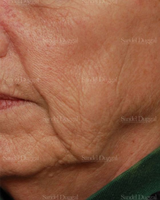 Laser Skin Resurfacing before, case 2975