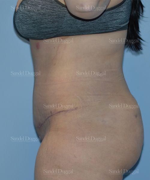 Tummy Tuck after, case 1701