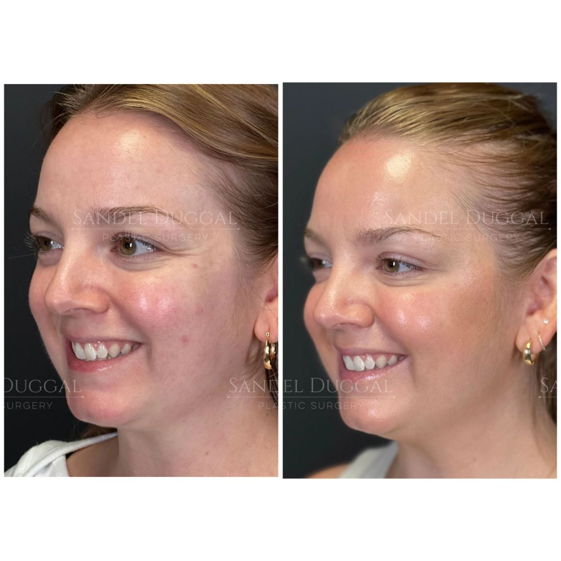 Botox & Fillers before and after, case 6006