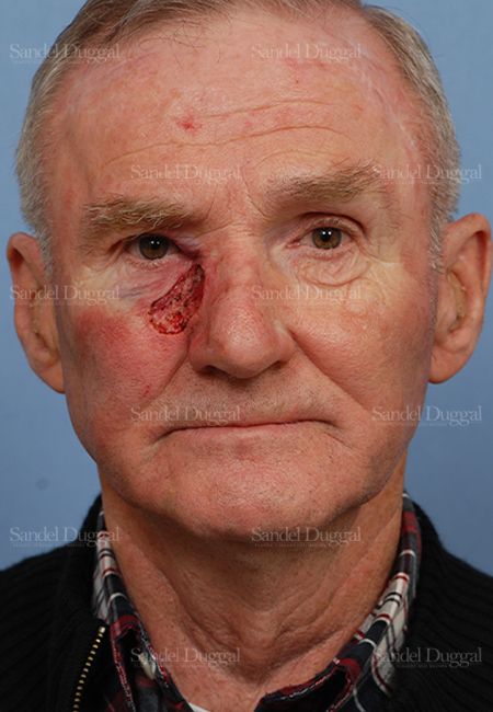 Reconstruction after Mohs before, case 2814