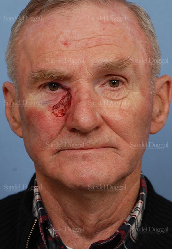 Reconstruction after Mohs before, case 2814