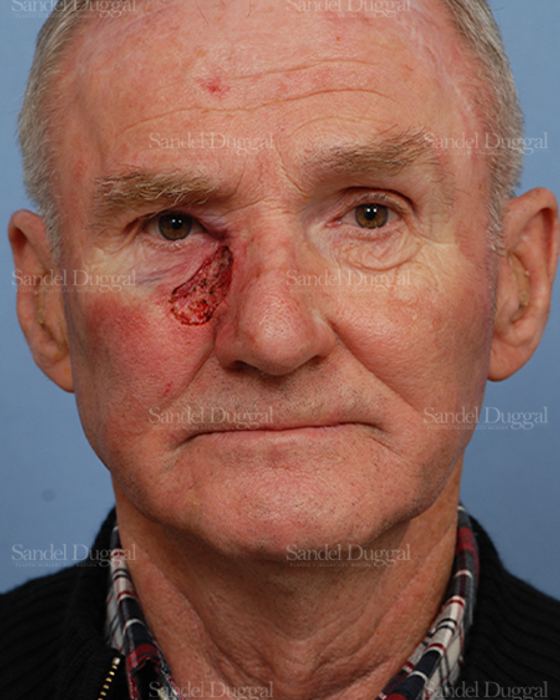 Reconstruction after Mohs before, case 2814