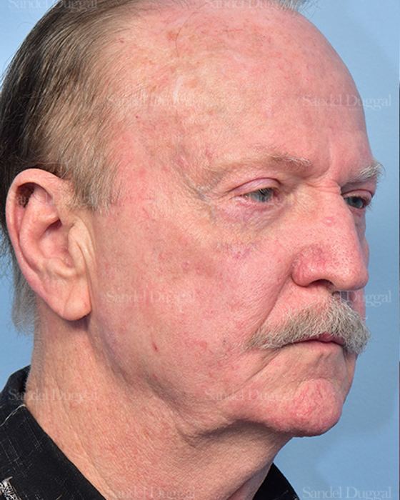 Facelift before, case 5748