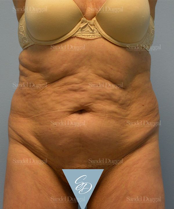 Tummy Tuck before, case 1729